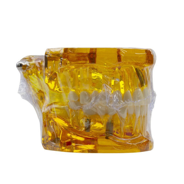 Dental Implant Restoration Model Oral Teaching Anatomical Models