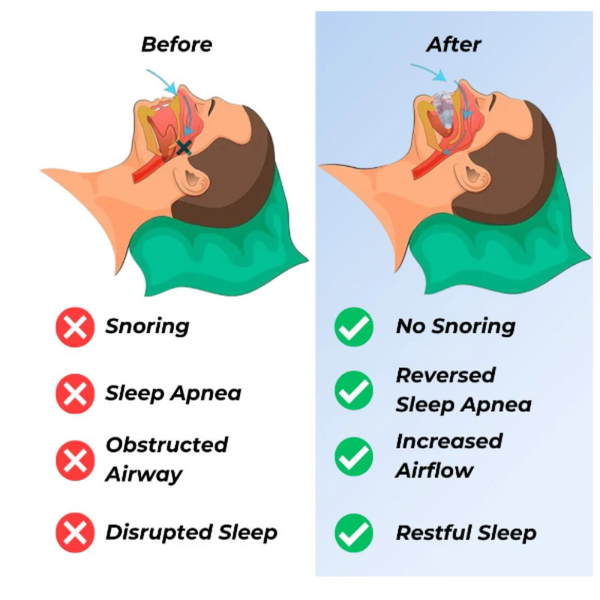 Braces For Anti Bruxism Teeth At Night Temporary Teeth & Supplies