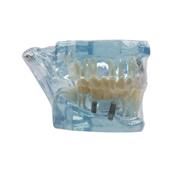 Dental Implant Restoration Model Oral Teaching Anatomical Models