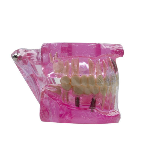 Dental Implant Restoration Model Oral Teaching Anatomical Models