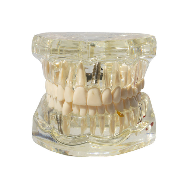 Dental Implant Restoration Model Oral Teaching Anatomical Models
