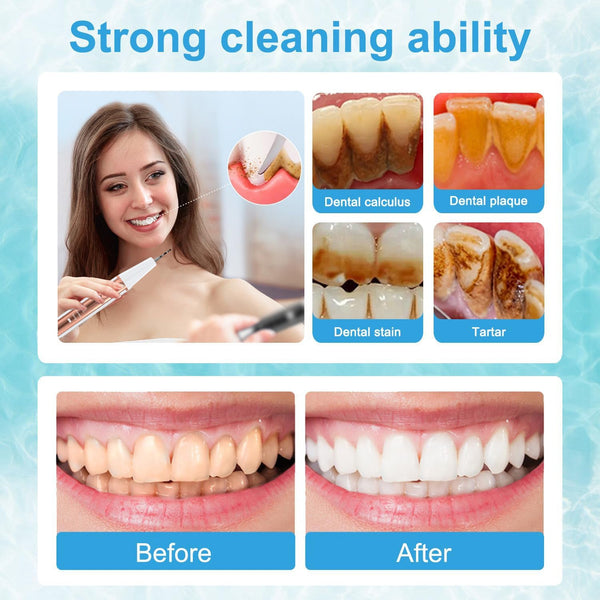 Ultrasonic Dental Scaler Kit Home Use Teeth Cleaner & Tartar Remover Dental Instruments