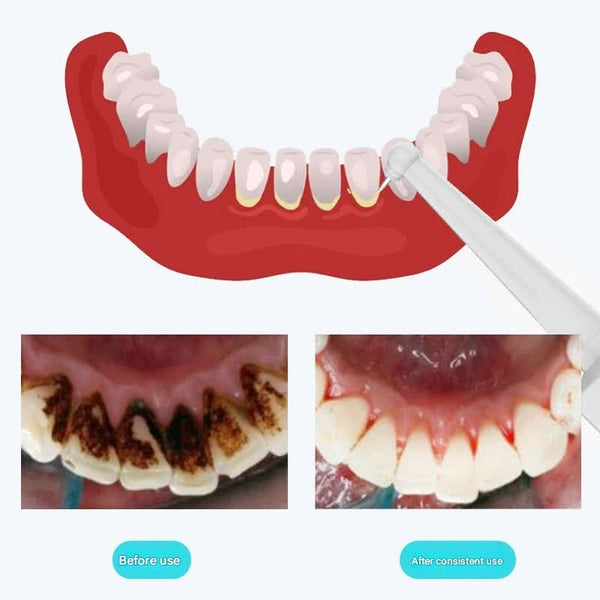 Ultrasonic Dental Scaler & Calculus Remover 3 Modes 2 Heads Led Light Blue Dental Instruments