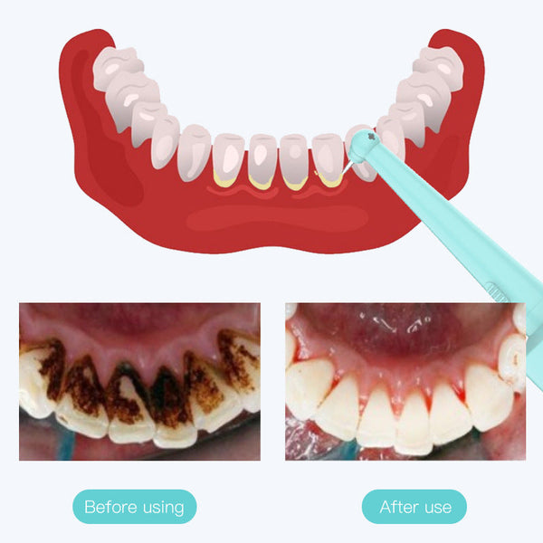 Intelligent High Frequency Vibration Dental Calculus & Stain Remover(Black) Dental Floss & Flossers