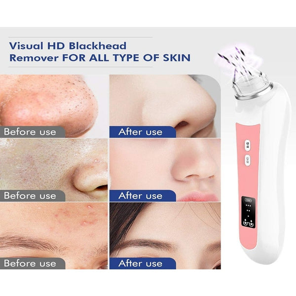 Blackhead Remover Vacuum Wifi 5.0Mp Visual Facial Pore Cleanser Pimple Sucker 1080P Hd 20X Microscope Camera Removal Facial Cleansing Devices