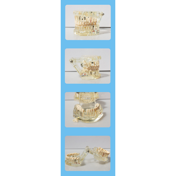 Dental Implant Restoration Model Oral Teaching Anatomical Models