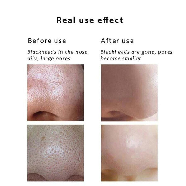 Professional Blackhead Remover Vacuum Acne Pimple Spot Suction Electric Facial Cleansing Devices