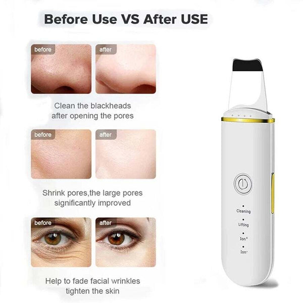 Ultrasonic Skin Scrubber Electric Vibration Deep Face Cleaning Peeling Shovel Facial Pore Cleaner Lifting Massager Beauty Device