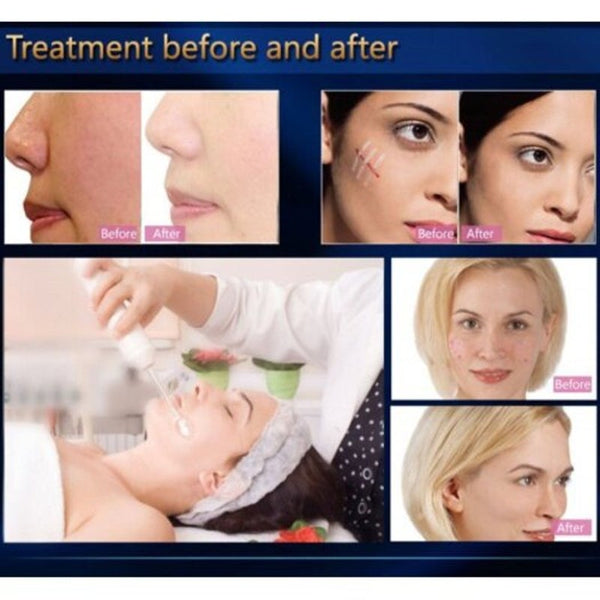 Handheld High Frequency Facial Machine Acne Anti Inflammatory Skin Tightening No Retail Package Anti Aging Products