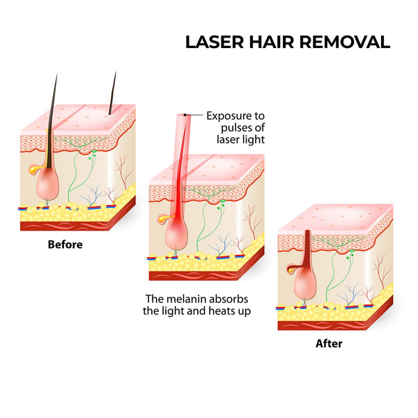 Silhouette Laser Hair Remover Permanent Epliation System Body Face Home Laser Hair Removal & Ipl